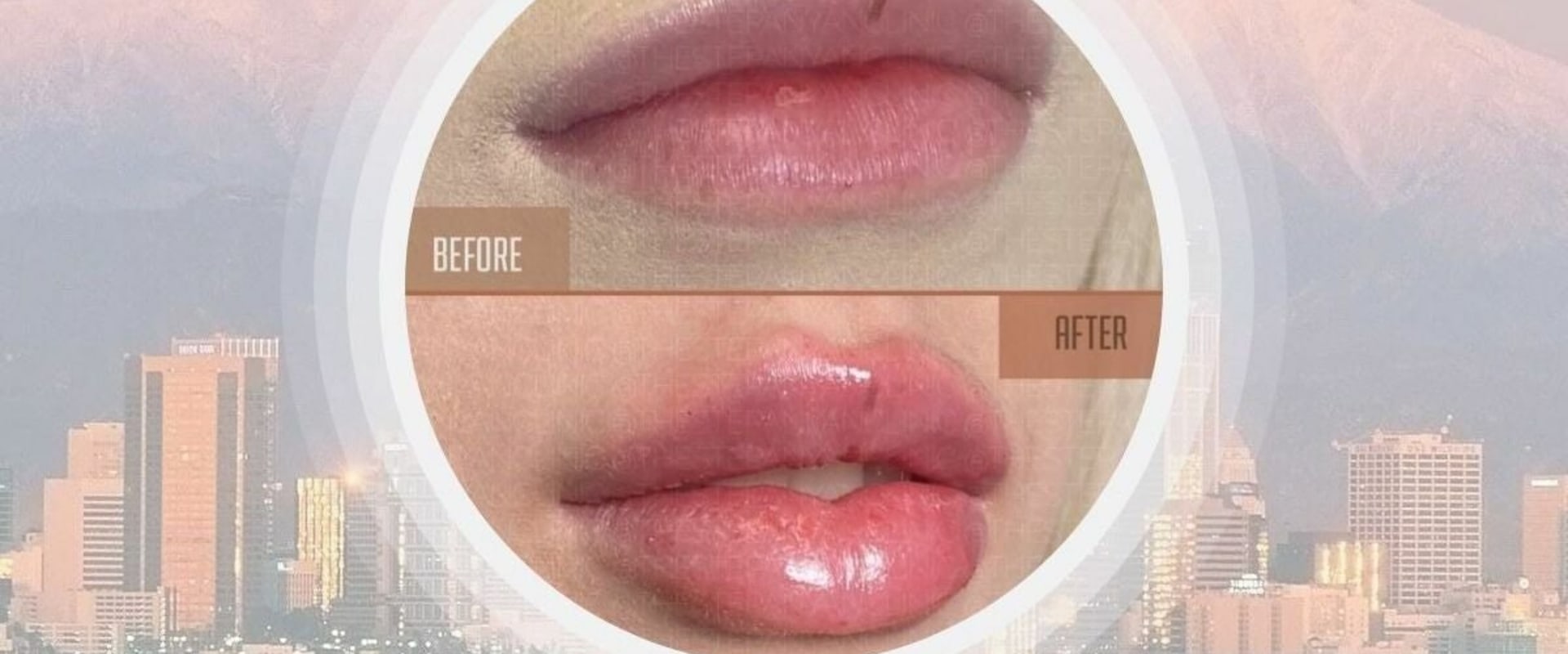 Skin Tightening, Botox and Lip Fillers by Skinsation LA: Enjoying Los Angeles