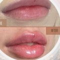 Skin Tightening, Botox and Lip Fillers by Skinsation LA: Enjoying Los Angeles